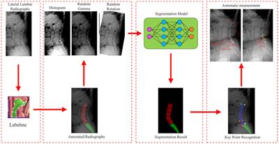 Artificial intelligence automatic measurement technology of lumbosacral radiographic parameters